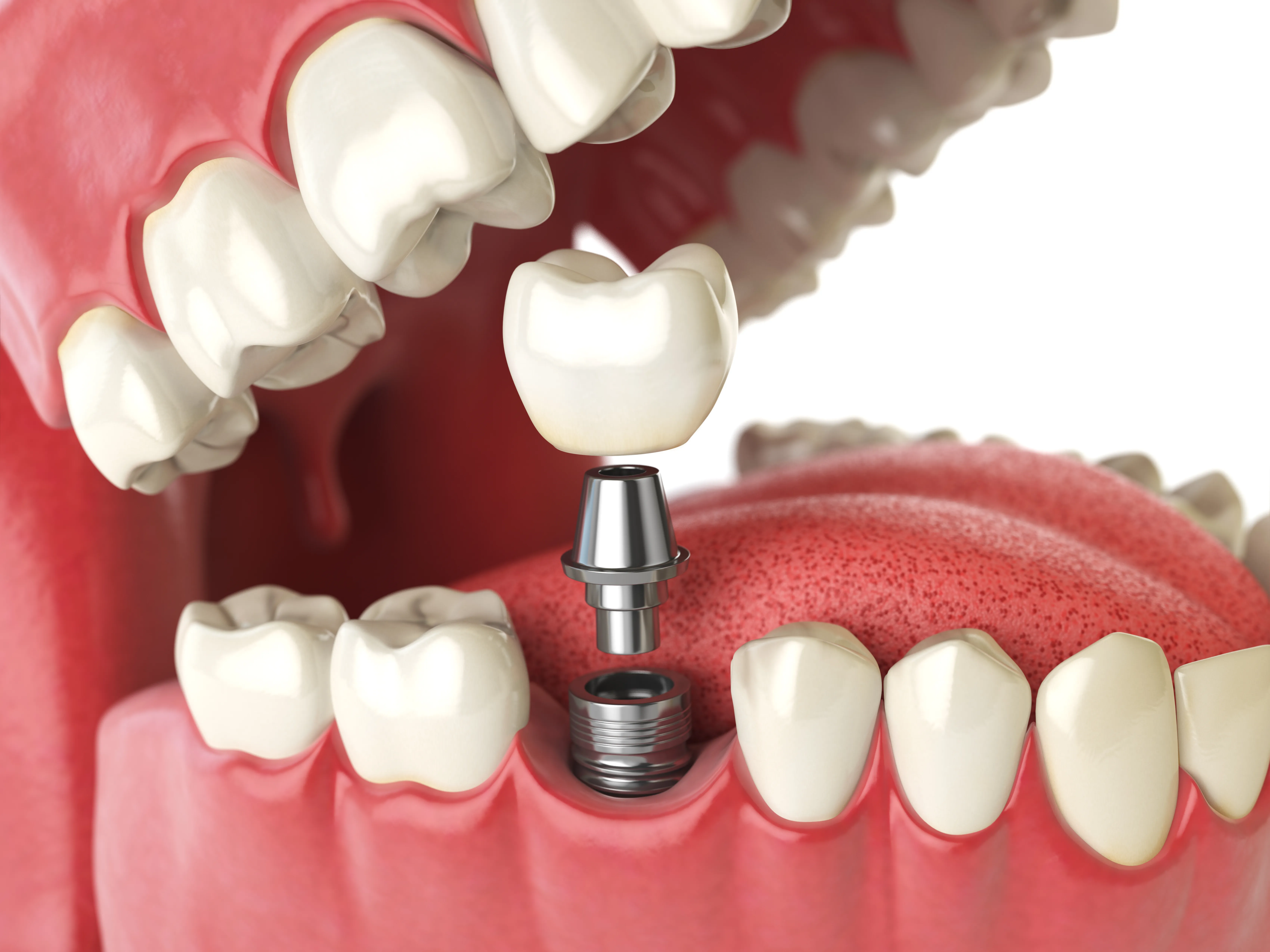 Why Dental Implants Are Perfect for Anyone Who Wants a Flawless Smile