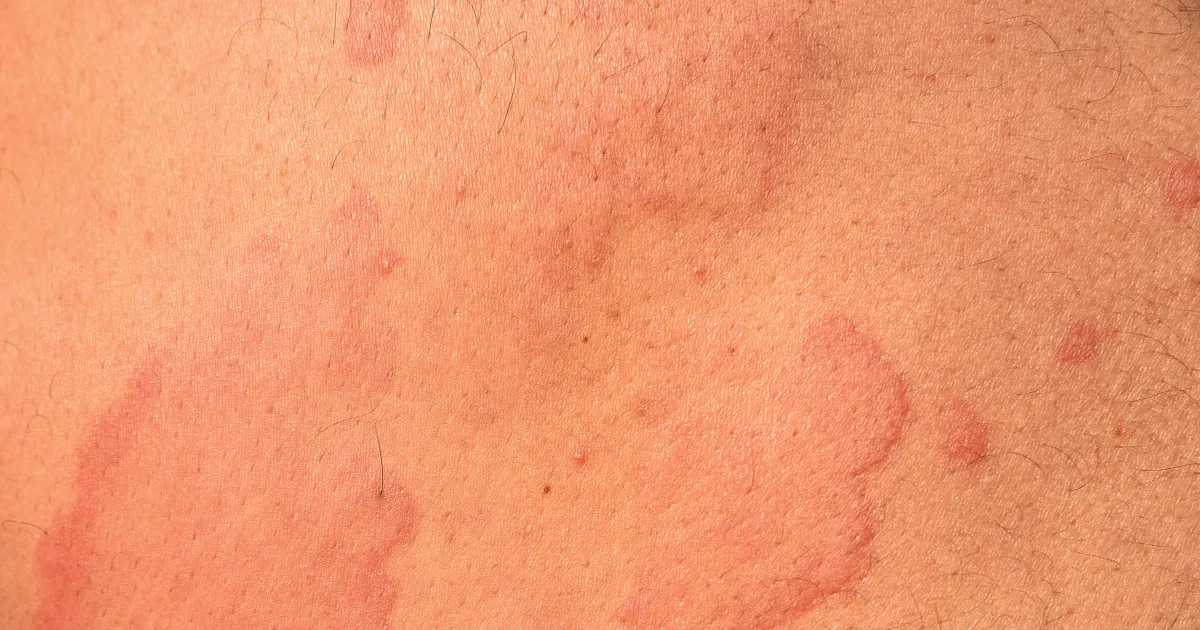 Hives the Facts You Need to Know