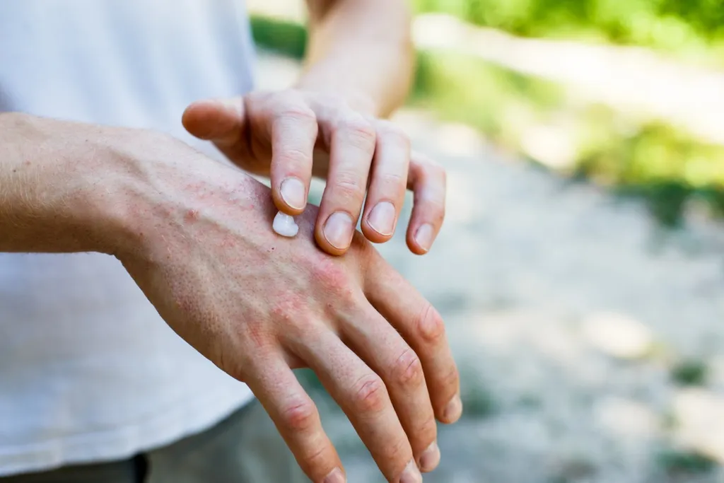 applying cream on hands with psoriasis