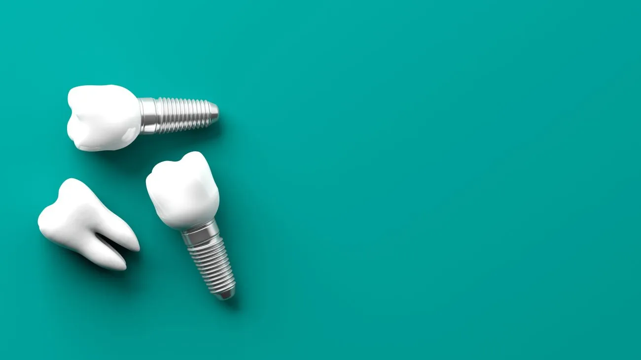 Op deze manier kunnen tandheelkundige implantaten de glimlach verbeteren