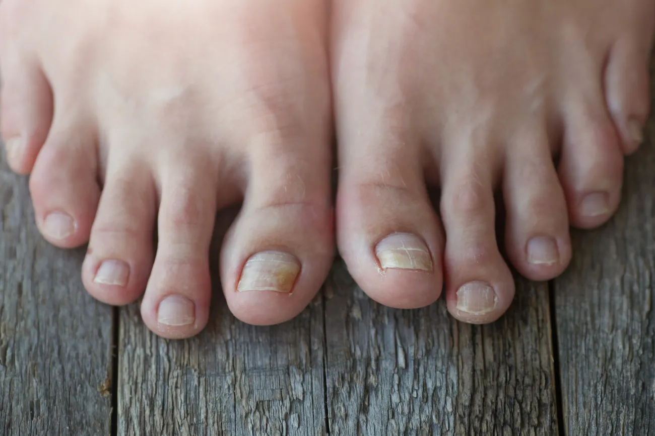 Toenail Fungus: Debunking Myths with Effective Natural Solutions ...