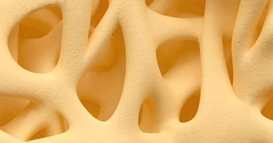 What You Need to Know About Osteoporosis