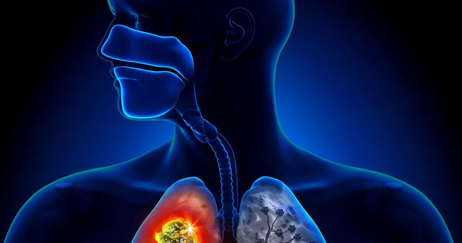 About Lung Cancer Treatments