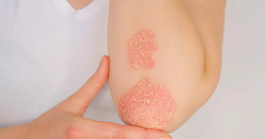 The Early Symptoms of Psoriatic Arthritis