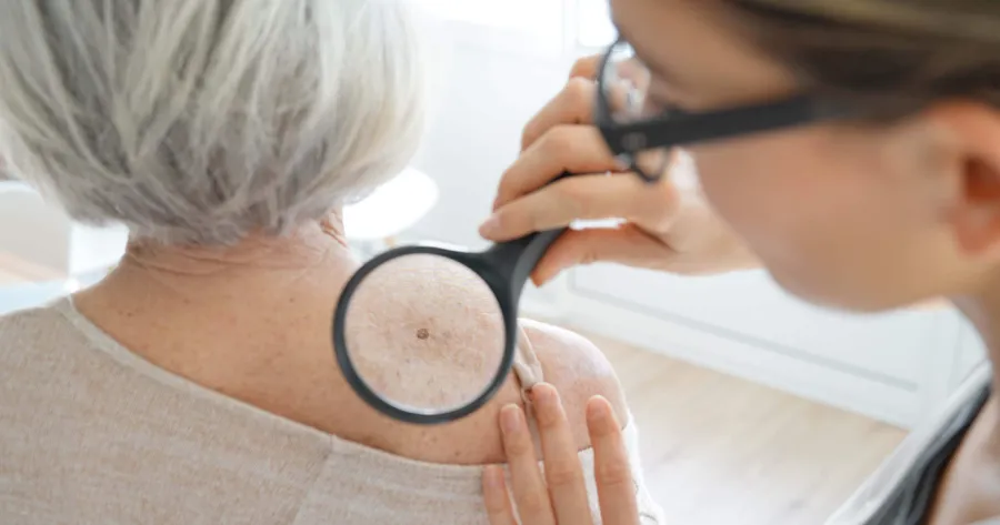 The Facts About Skin Cancer
