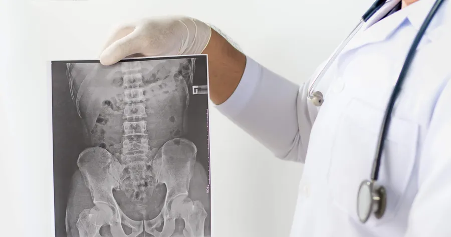 Ankylosing Spondylitis (AS): Early Signs, Symptoms, and Treatments