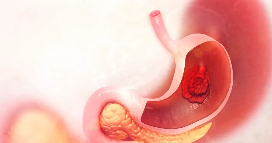 What You Need to Know About Gastric Cancer