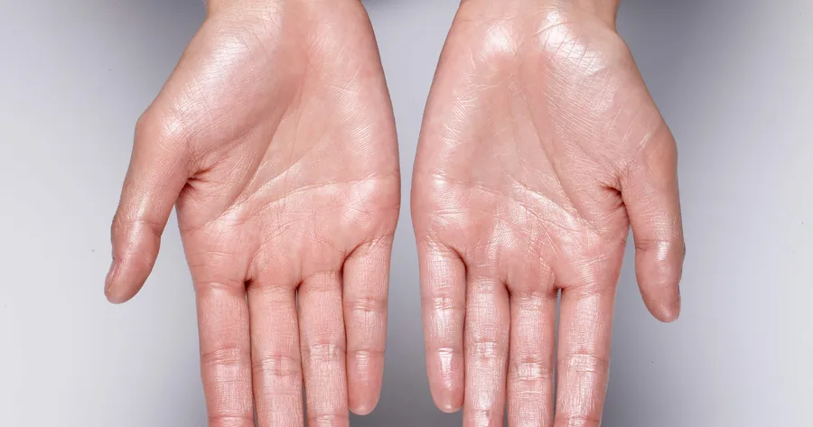 Living With Hyperhidrosis: Causes, Symptoms, and Treatments