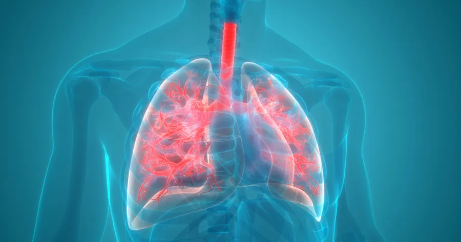 The Signs and Symptoms of Pneumonia