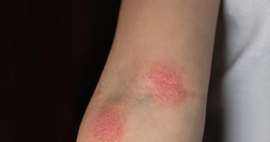 Mycosis Fungoides Rash: Early Signs and Treatment Options