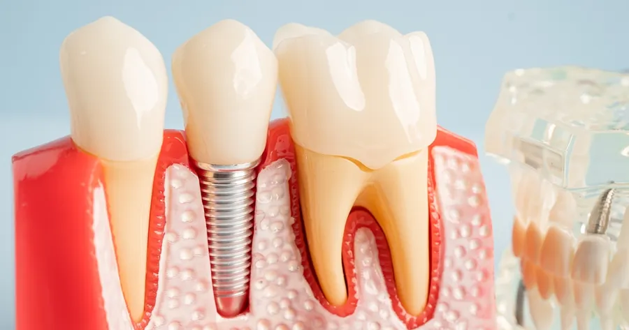 Dental Implants Without the High Price – Dental Schools Make It Possible