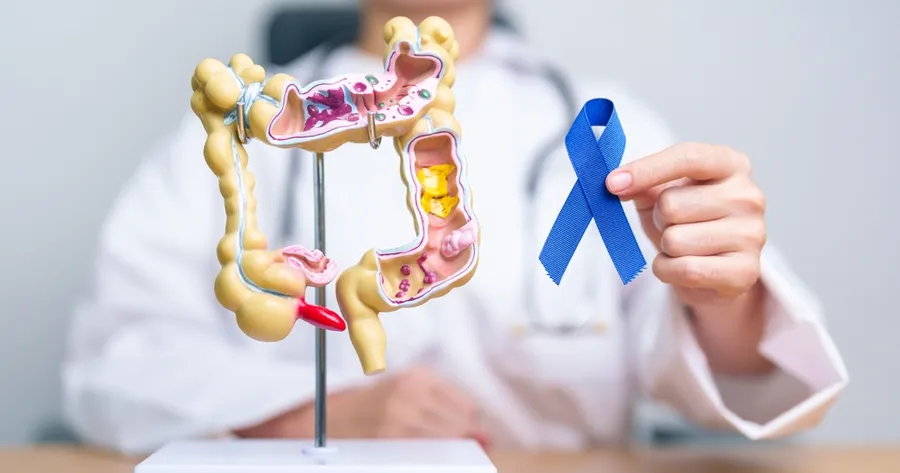 Colon Cancer: What You Need To Know