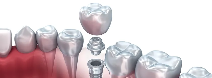 Everything You Need to Know About Dental Implants