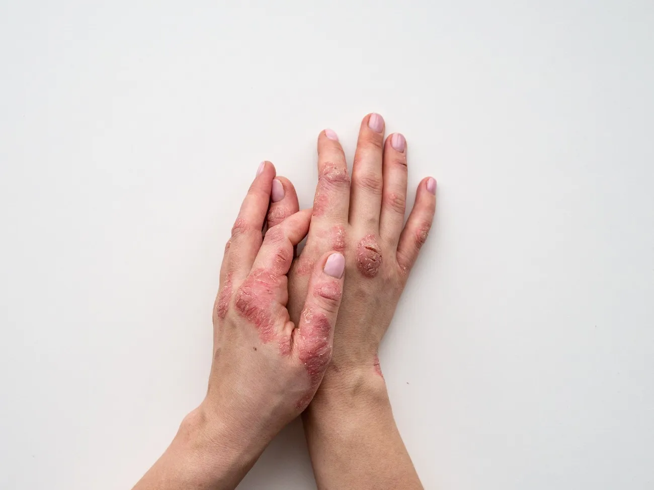 Itchy Patches: How to Know If It’s Psoriasis or Something Else