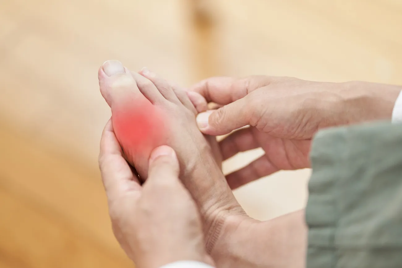 Are You At Risk of Developing Gout?