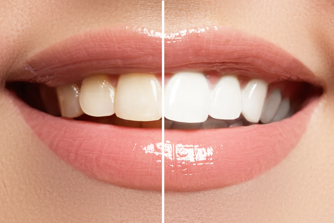 Transform Your Smile: 7 Best Teeth Whitening Toothpastes of 2023