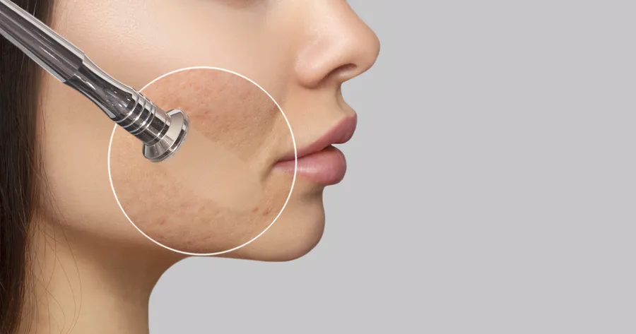 Advanced Acne Scar Treatments: Lasers, Peels, and More