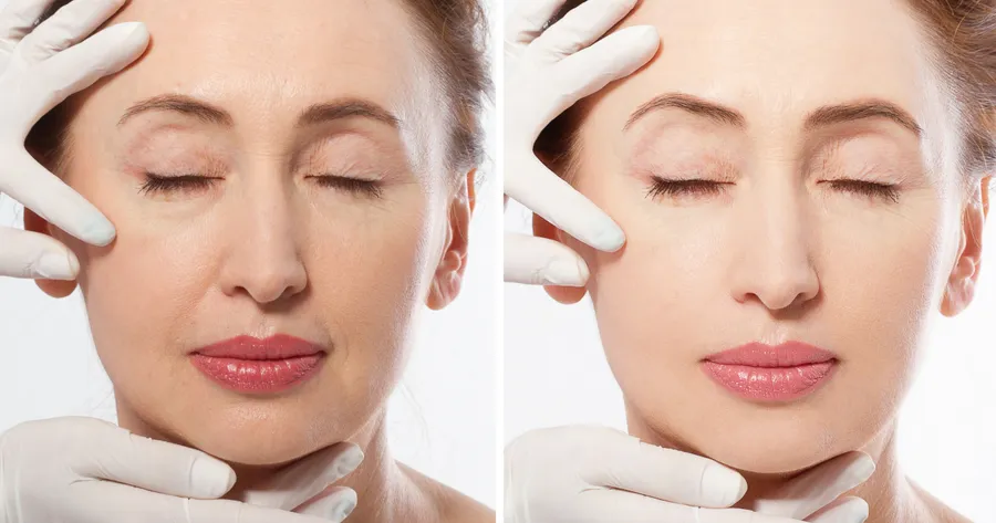 Want a Mini Facelift? Juvéderm Can Rejuvenate Your Look