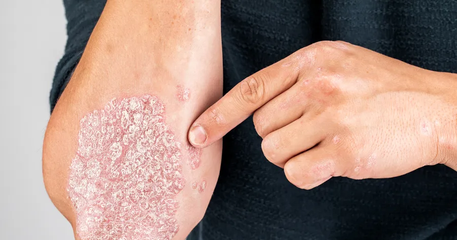 Plaque Psoriasis: What You Need To Know