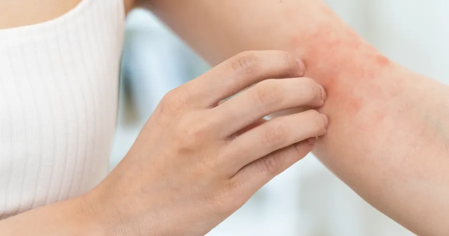 Atopic Dermatitis: What You Need To Know