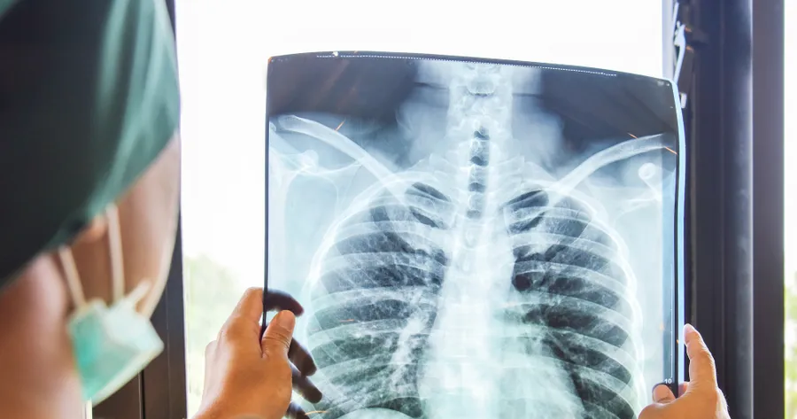 What You Need To Know About Lung Cancer