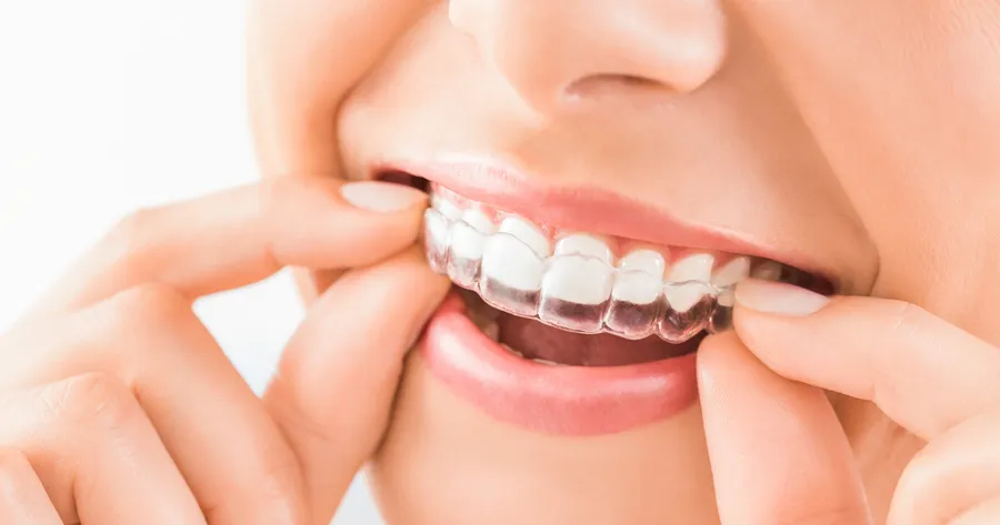 Invisalign: The Modern Approach to Teeth Alignment