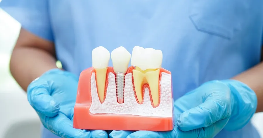 How Do Dental Implants Compare to Traditional Dentures?