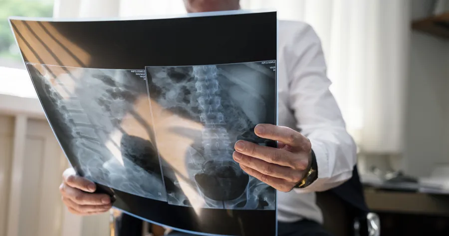 Understanding Spinal Atrophy vs Spinal Stenosis: Diagnosis and Treatment