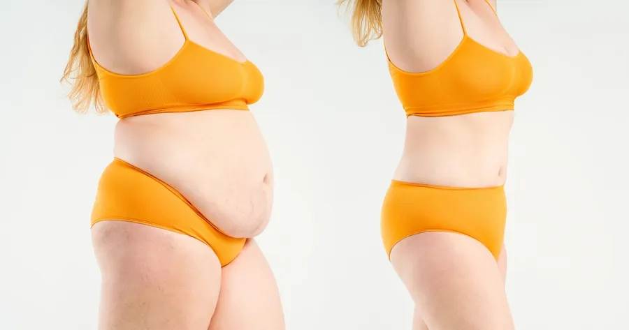 Abdominoplasty Costs: Key Factors That Impact the Price of a Tummy Tuck