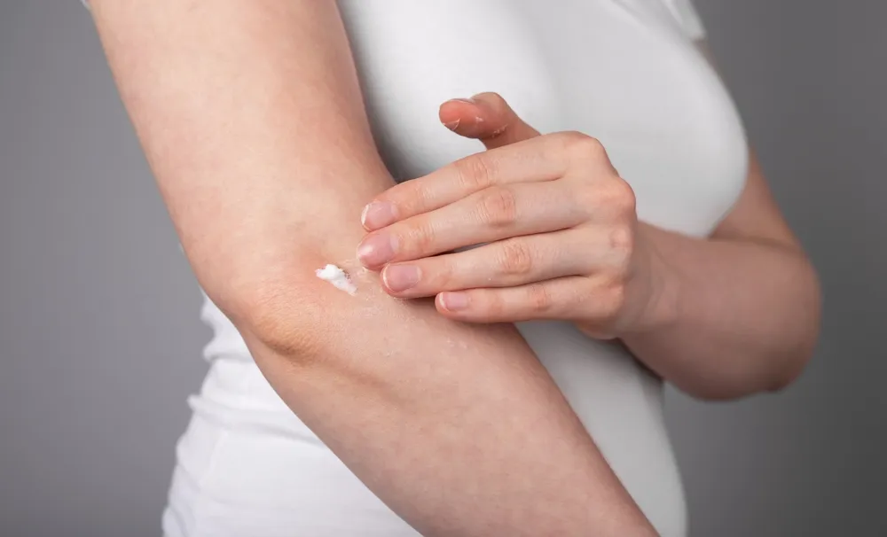 Exploring the Best Treatments for Atopic Dermatitis