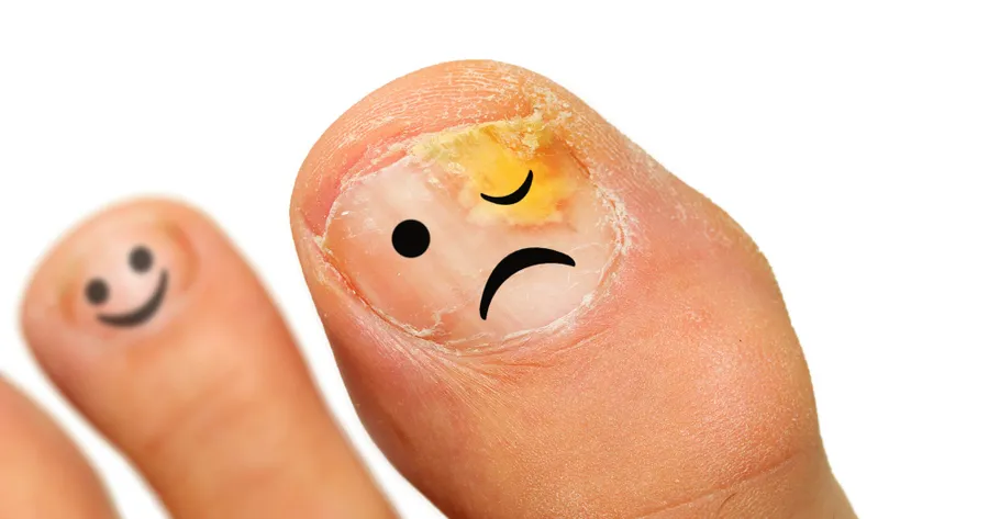 Natural Treatments for Toenail Fungus Infections