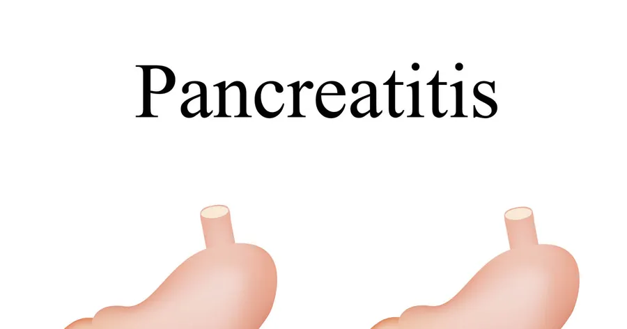 Pancreatitis Treatment Options