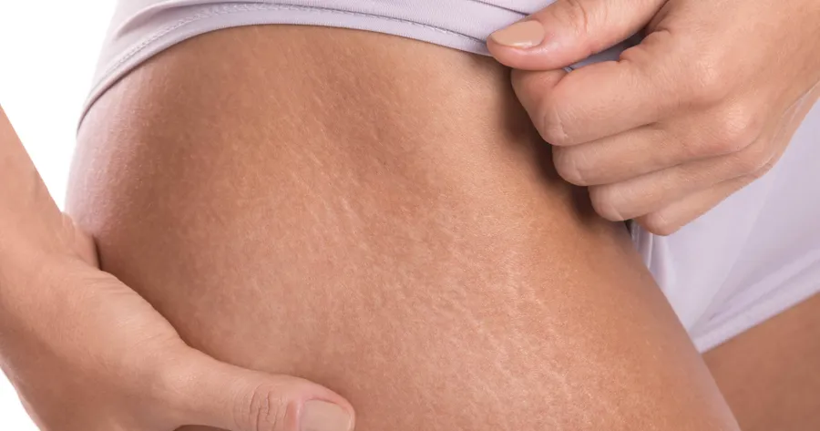 Where Do Stretch Marks Come From?