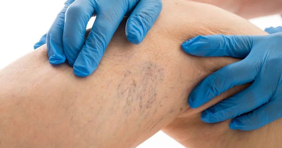 Popular Methods for Getting Rid of Spider Veins