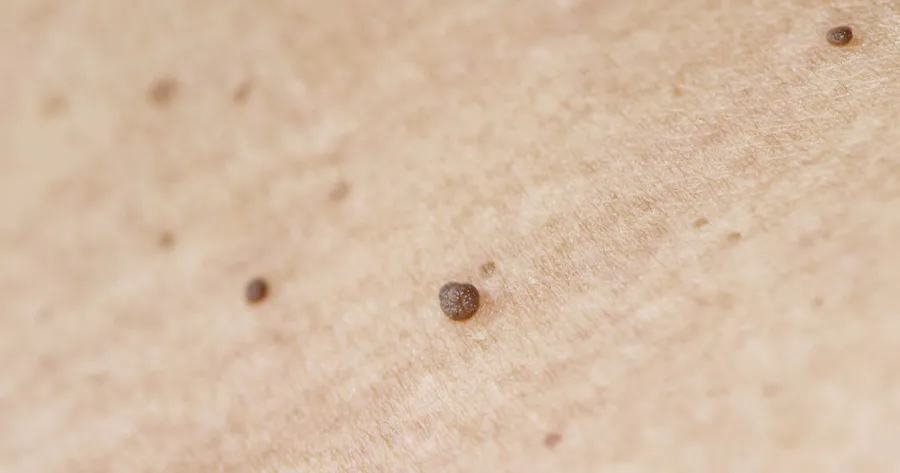 Is it a Skin Tag or a Wart?