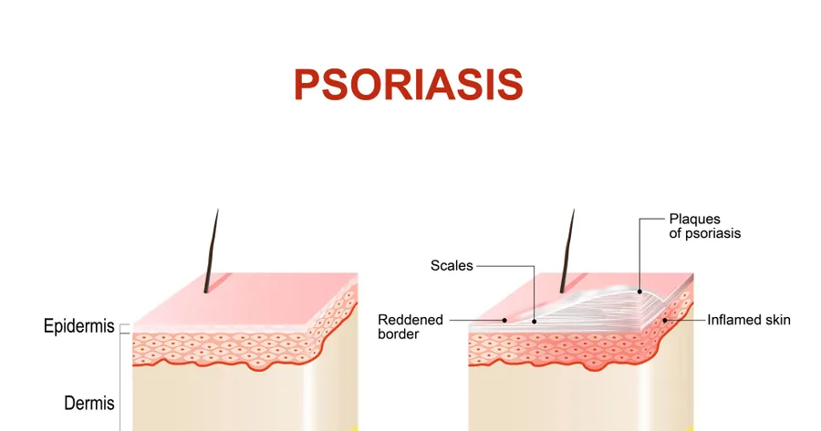Dietary Causes of Psoriasis