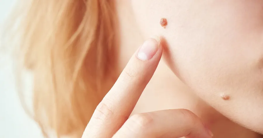 How to Remove Moles With Hydrogen Peroxide