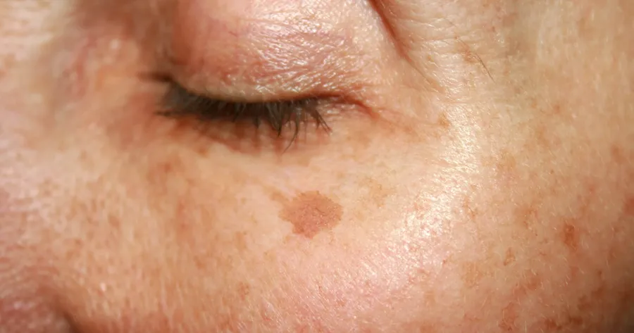 How to Remove Age Spots Permanently