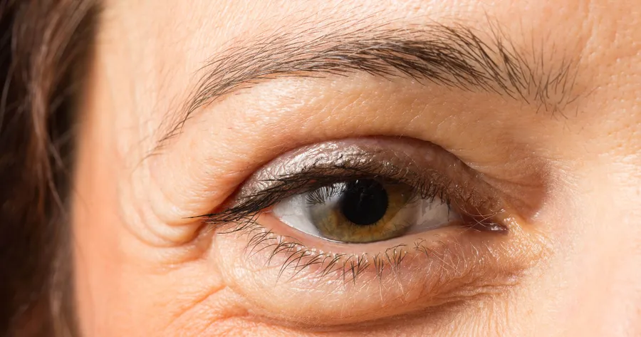 How to Stop Swelling in the Eyelid