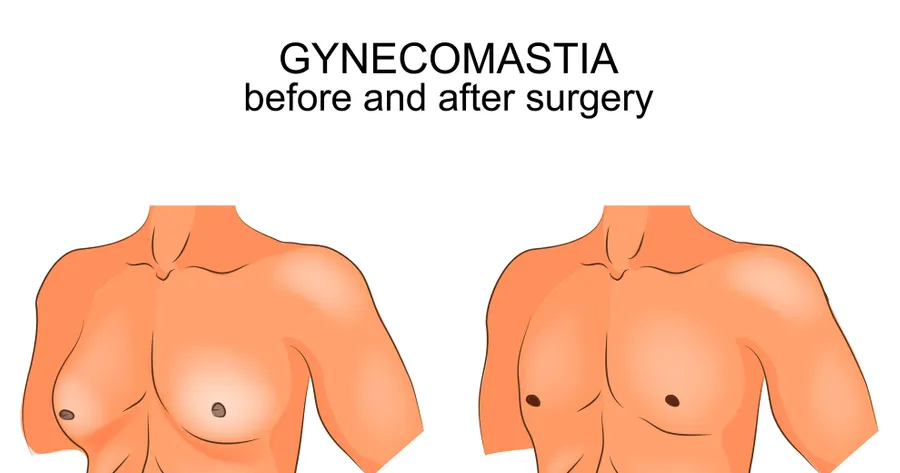 How to Hide Gynecomastia