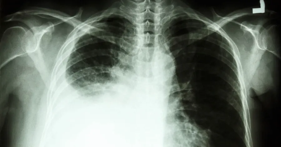 What Are the Treatments for Black Lung Disease?