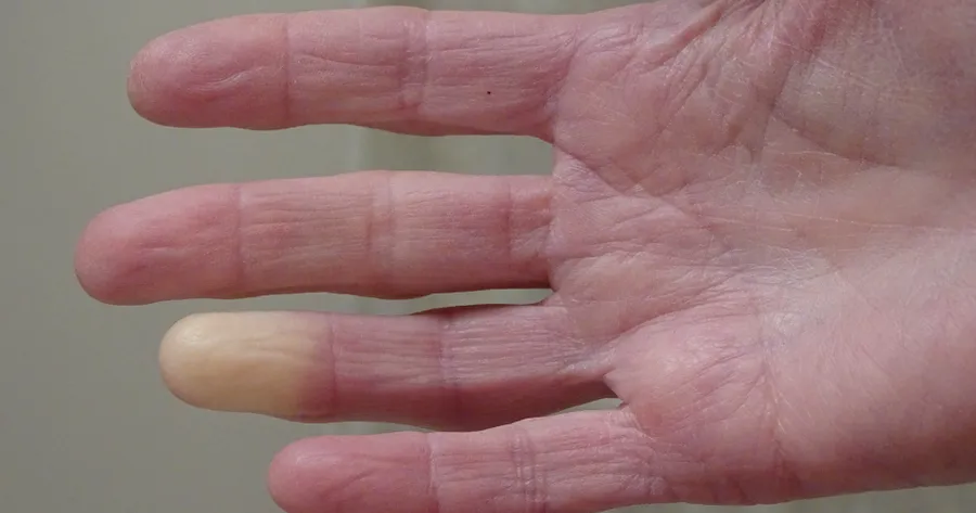 Raynaud’s Disease vs. Raynaud’s Phenomenon