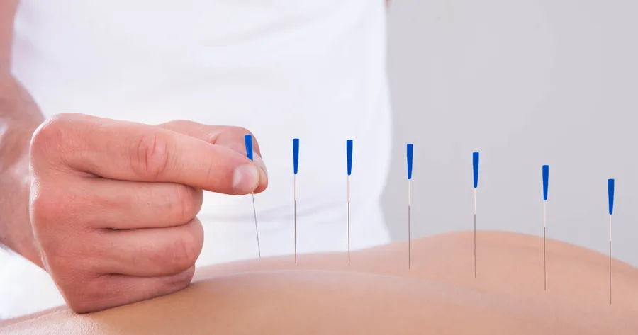 How Acupuncture May Help Sciatica