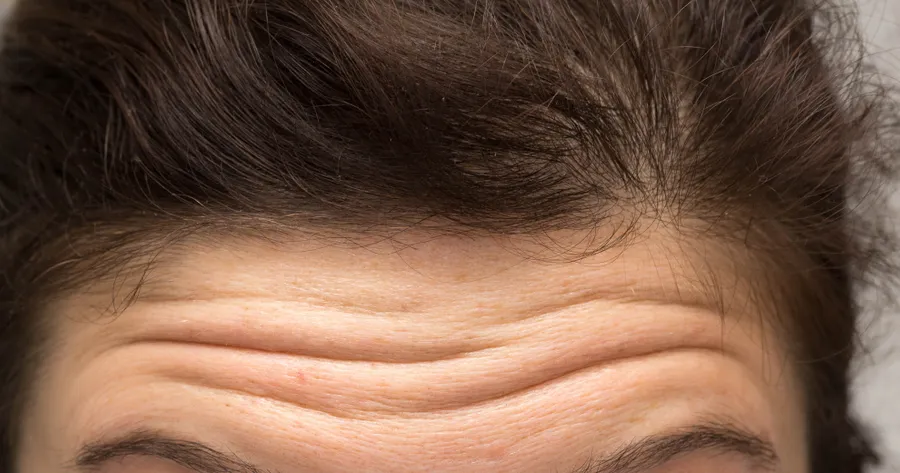 Natural Remedies to Get Rid of Wrinkles on Forehead