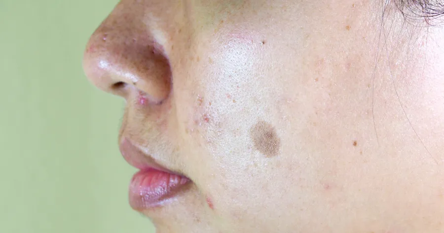 Melasma Treatment Options