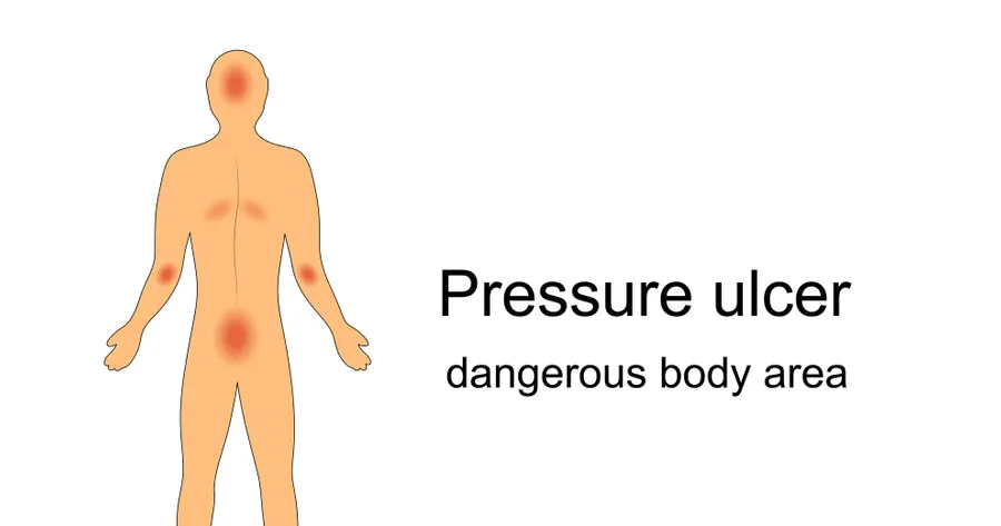 How to Heal Pressure Ulcers