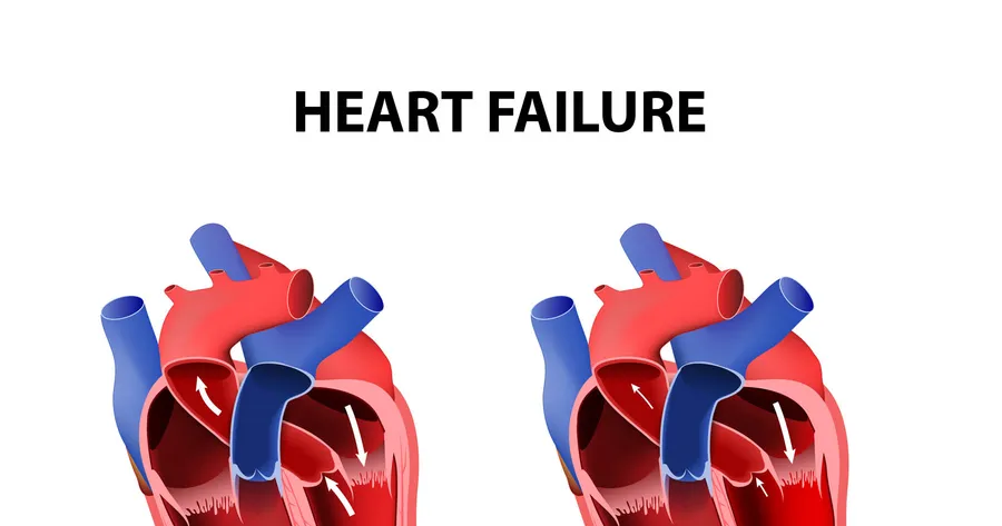 Congestive Heart Failure Fact Sheet