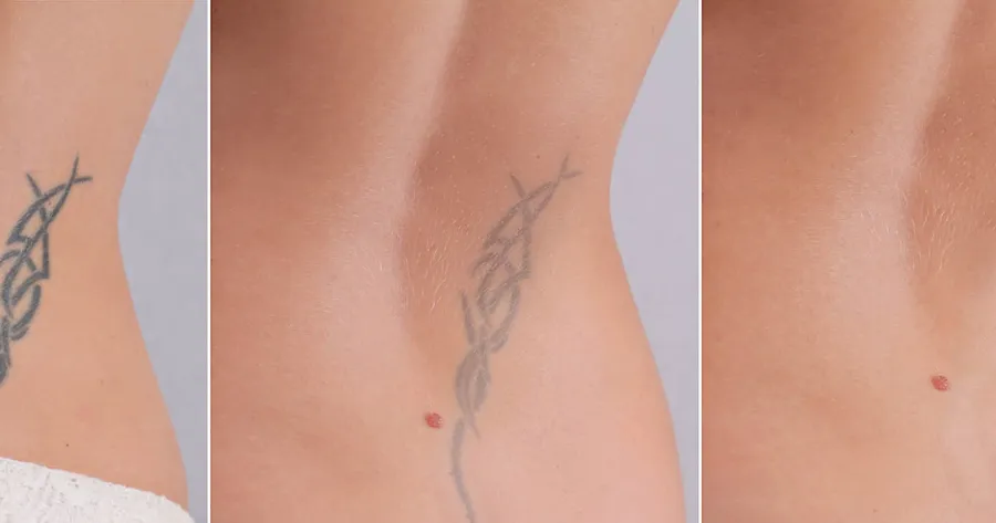 Skin Peel Tattoo Removal