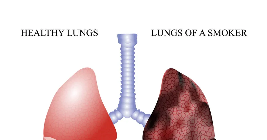 Is There a Treatment for Lung Cancer?