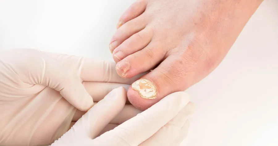 Remedies for Tonail Fungus